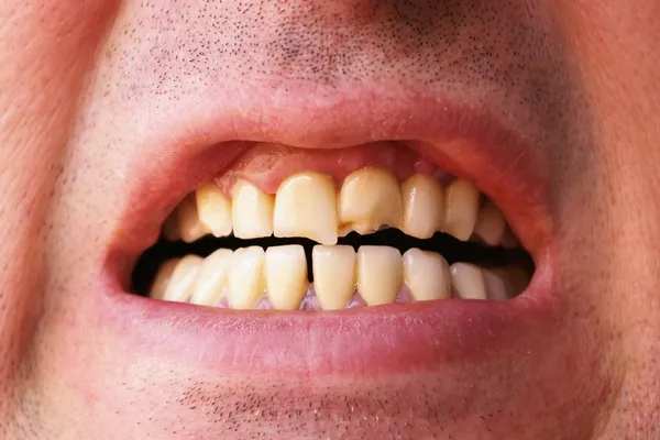 Denti rotti — Foto Stock