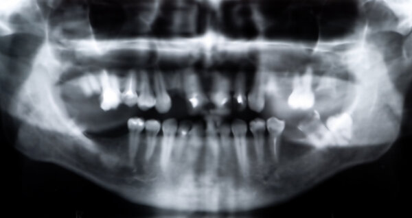 Panoramic x-ray picture of a mouth