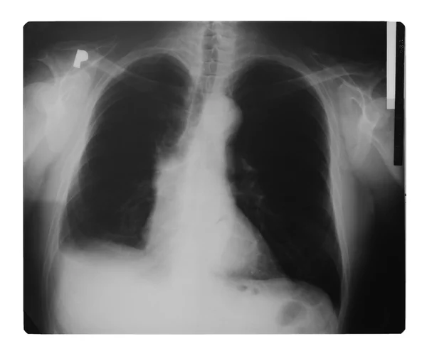 Klatki piersiowej x ray — Zdjęcie stockowe
