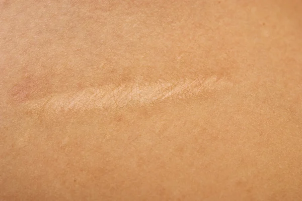Scar on skin — Stock Photo, Image