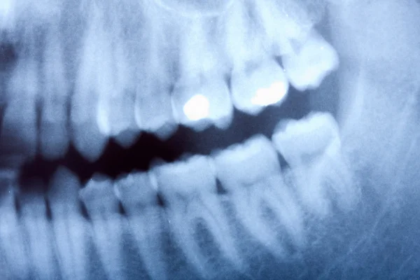 Raio-X dentário — Fotografia de Stock