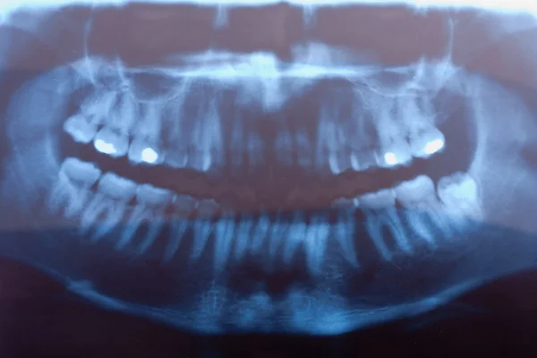 Raio-X dentário — Fotografia de Stock