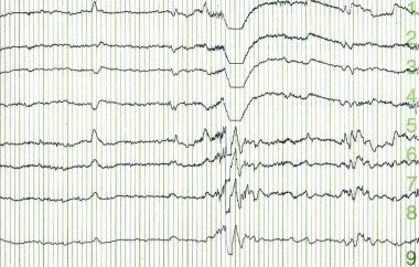 Electro-encephalogramme clipart