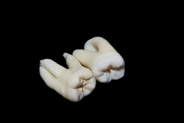 提取人类的牙齿 — 图库照片