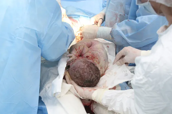 Baby being born during cesarean section — Stock Photo, Image