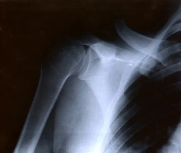 Broken collar bone — Stock Photo, Image