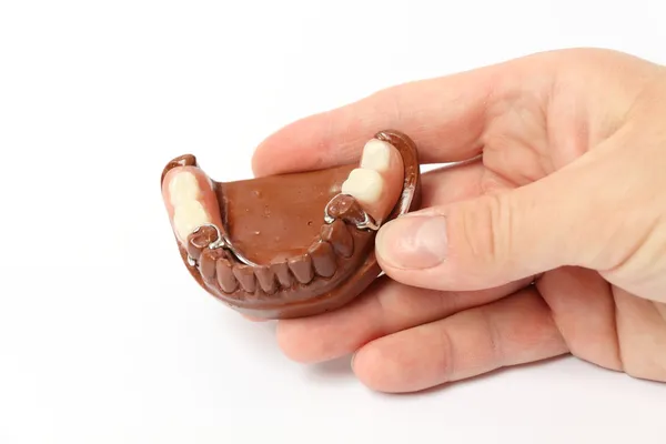 Coronas de porcelana, puente (odontología ) —  Fotos de Stock