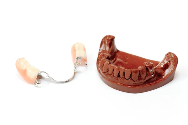 歯科用石膏鋳型、入れ歯 — ストック写真