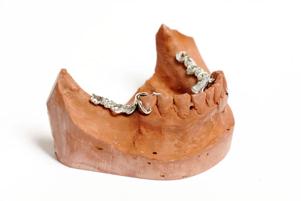 Moldes de yeso dental, prótesis dentales — Foto de Stock