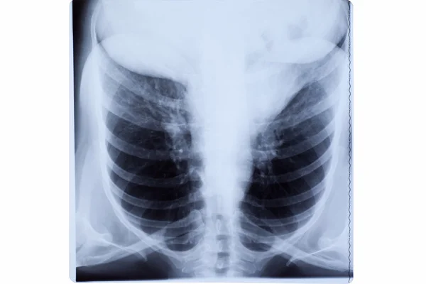 Radiografia de tórax de mulher — Fotografia de Stock