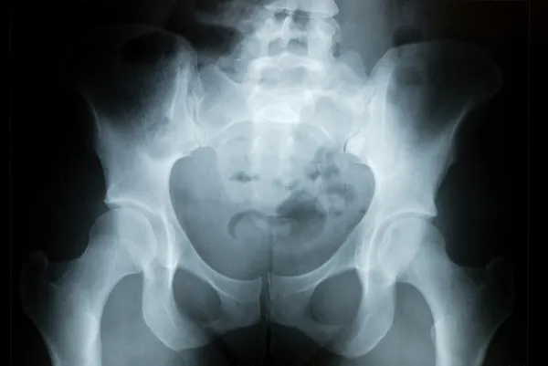 骨盆 x 射线 — 图库照片
