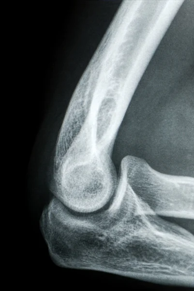Elbow X-ray — Stock Photo, Image