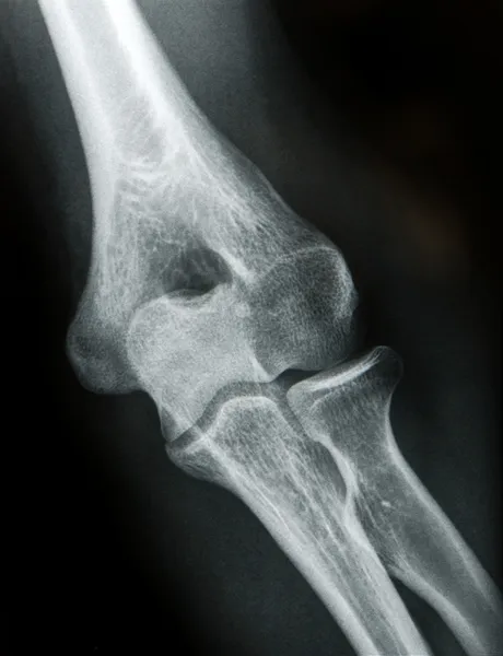 Radiografia do cotovelo — Fotografia de Stock