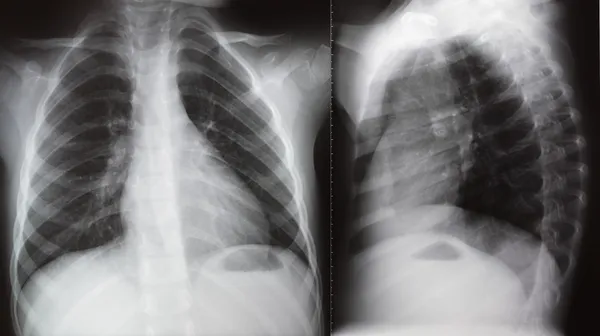 Radiazioni polmonari radiografia toracica Foto Stock Royalty Free