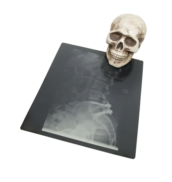 Huesos y rayos X —  Fotos de Stock