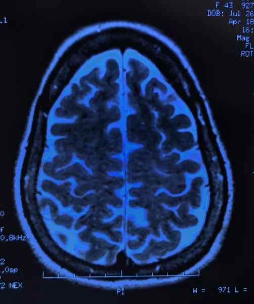 stock image Brain MRI