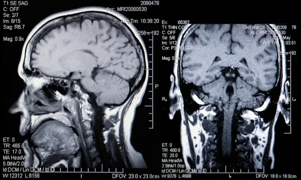Gerçek MRI taramaları baş ve beyin — Stok fotoğraf