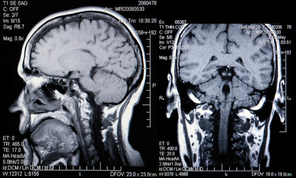 Реальная МРТ головы и мозга
