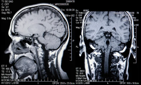 RM reale Scansioni della testa e del cervello Fotografia Stock