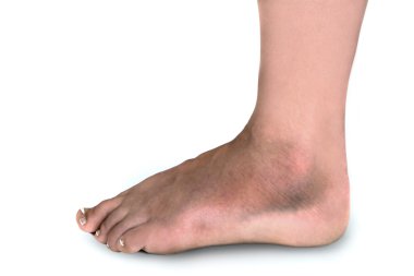 Woman With Broken Foot clipart