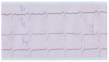 Long stripe of ecg clipart