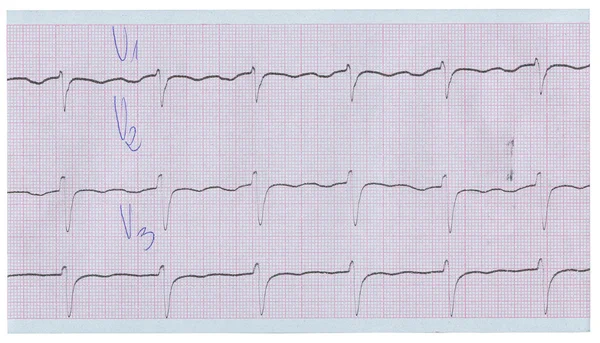 Długi pasek EKG — Zdjęcie stockowe