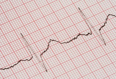 ECG graph clipart