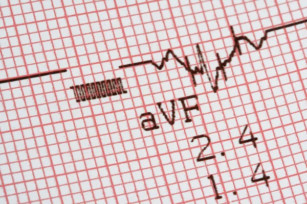 Cardiographical test results — Stock Photo, Image