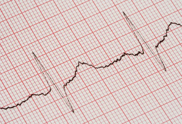 EKG grafikon — Stock Fotó