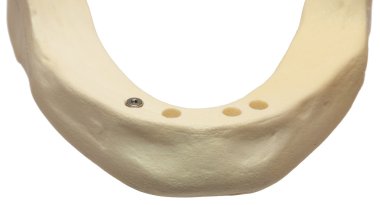 Dental Mouth Jaw Bone With Implant clipart