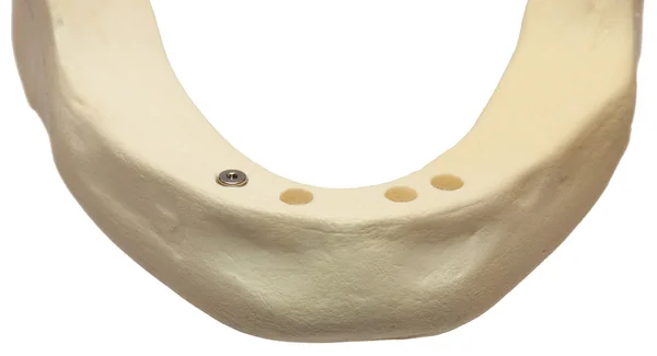 Hueso de mandíbula bucal dental con implante Imagen de archivo
