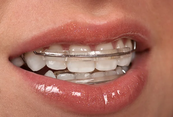 Kosmetische Zahnspange — Stockfoto