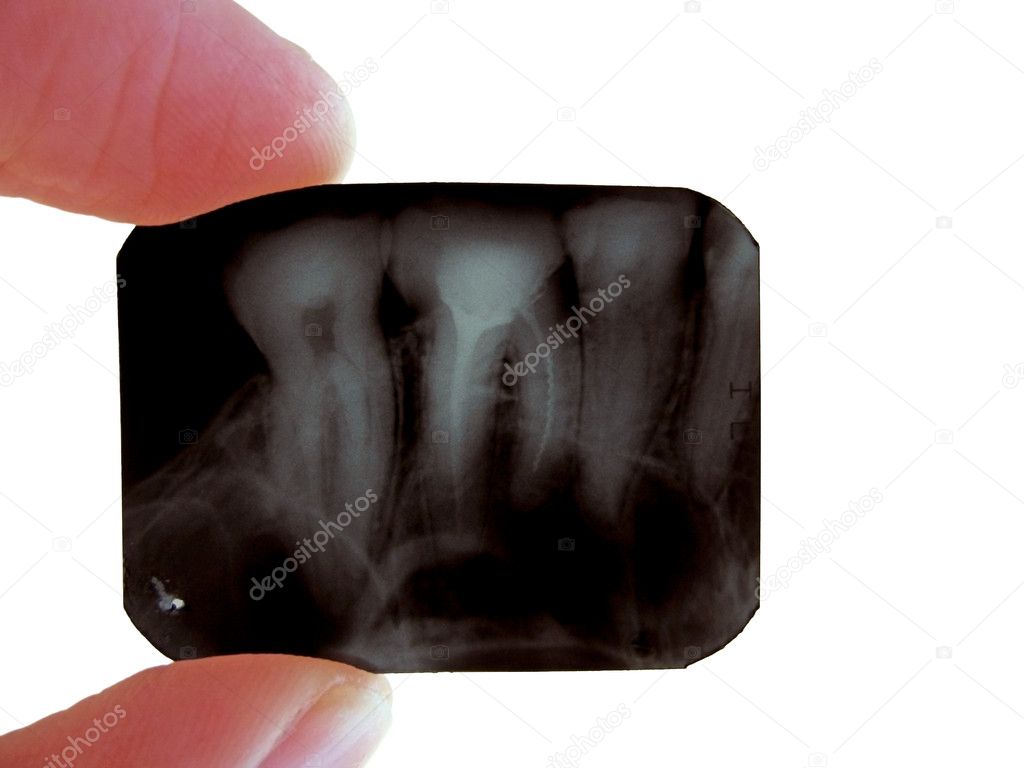 Roentgenogram of teeth
