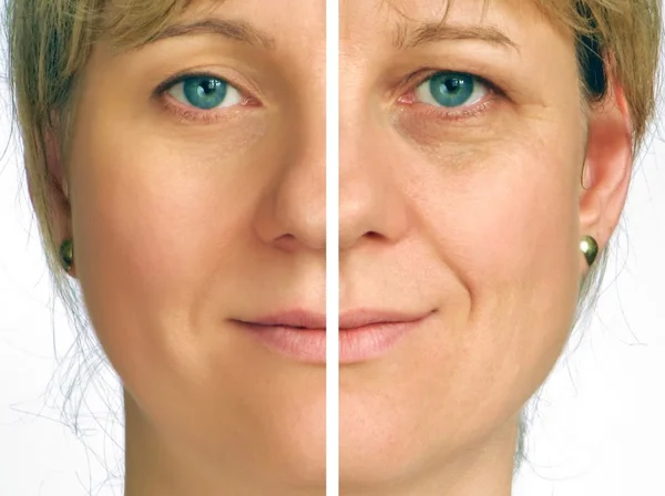 Correction of wrinkles - half face — Stock Photo, Image