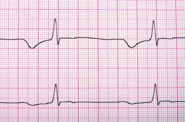 Ecg graph clipart