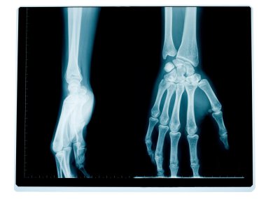 Hand and wrist radiography clipart