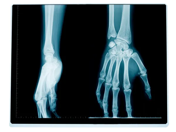 Hand en pols radiografie — Stockfoto