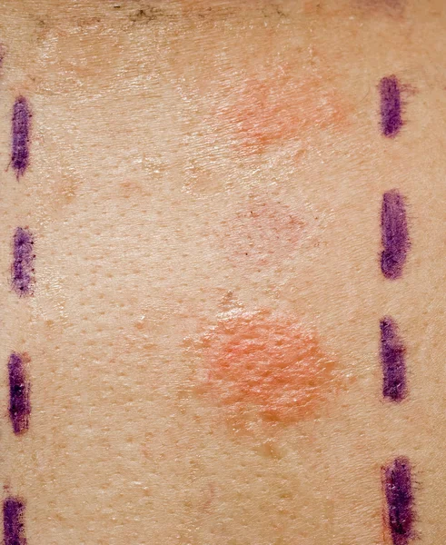 Test di allergia cutanea — Foto Stock