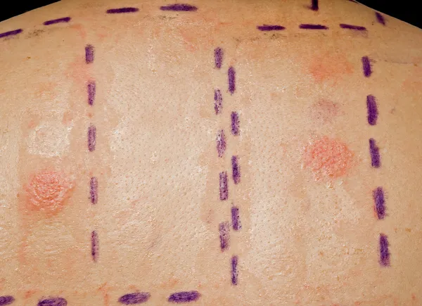 Аллергия на кожу — стоковое фото
