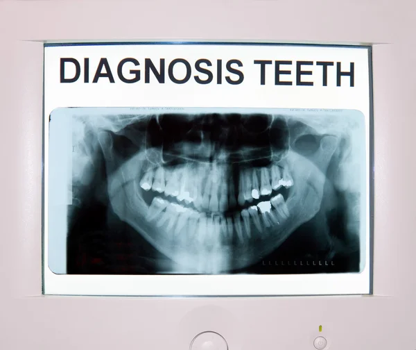 Denti a raggi X sul monitor Immagine Stock
