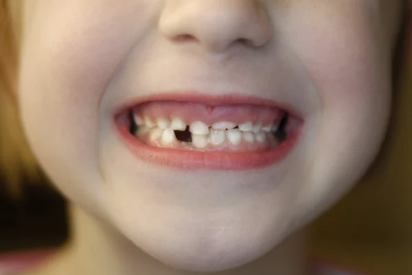 Elveszett fogak — Stock Fotó