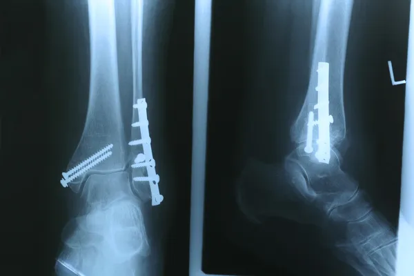 X 射线的脚 — 图库照片