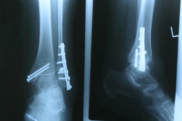 다리의 엑스레이 로열티 프리 스톡 사진
