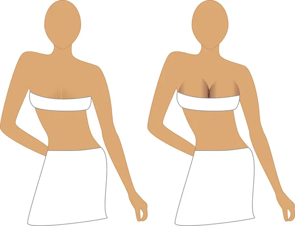 乳房植入 — 图库矢量图片