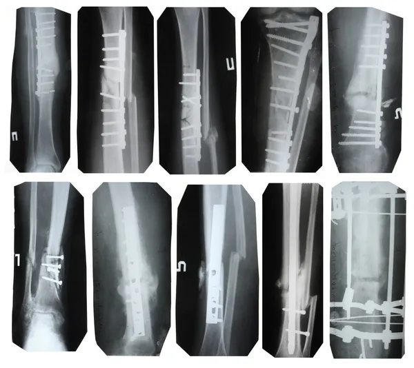 Broken leg collection - x-ray pictures — Stock Photo, Image