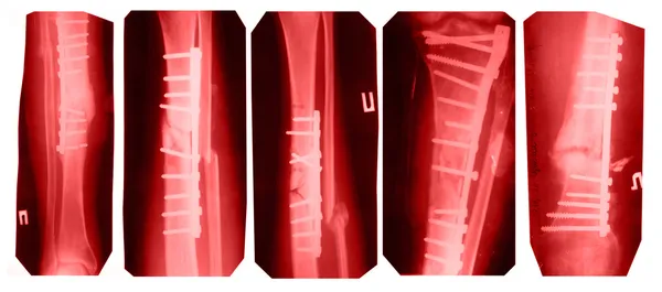Broken leg collection - x-ray pictures — Stock Photo, Image