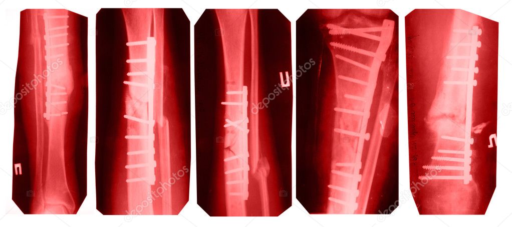 Broken leg collection - x-ray pictures