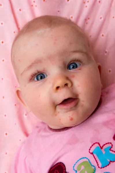 鶏痘と赤ちゃん — ストック写真