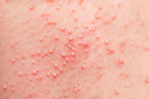 Allergic rash — Stock Photo, Image