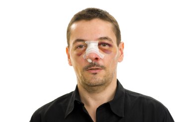 Broken nose and black eyes clipart